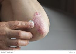 Psoriasis