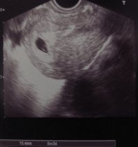 Ultraschall_20080331_02aklein.jpg